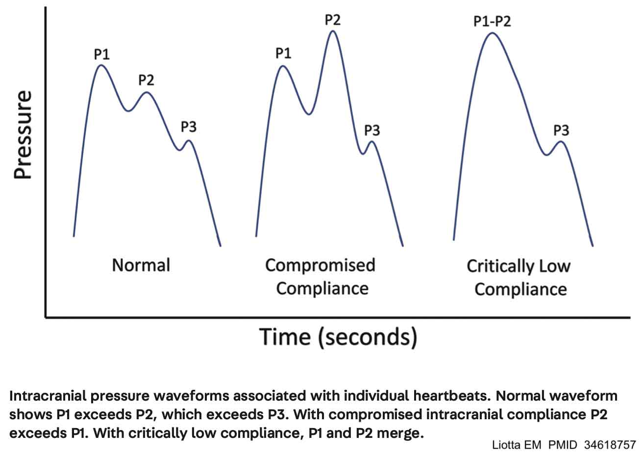 Intracranial Pressure Monitoring Chart Easy
