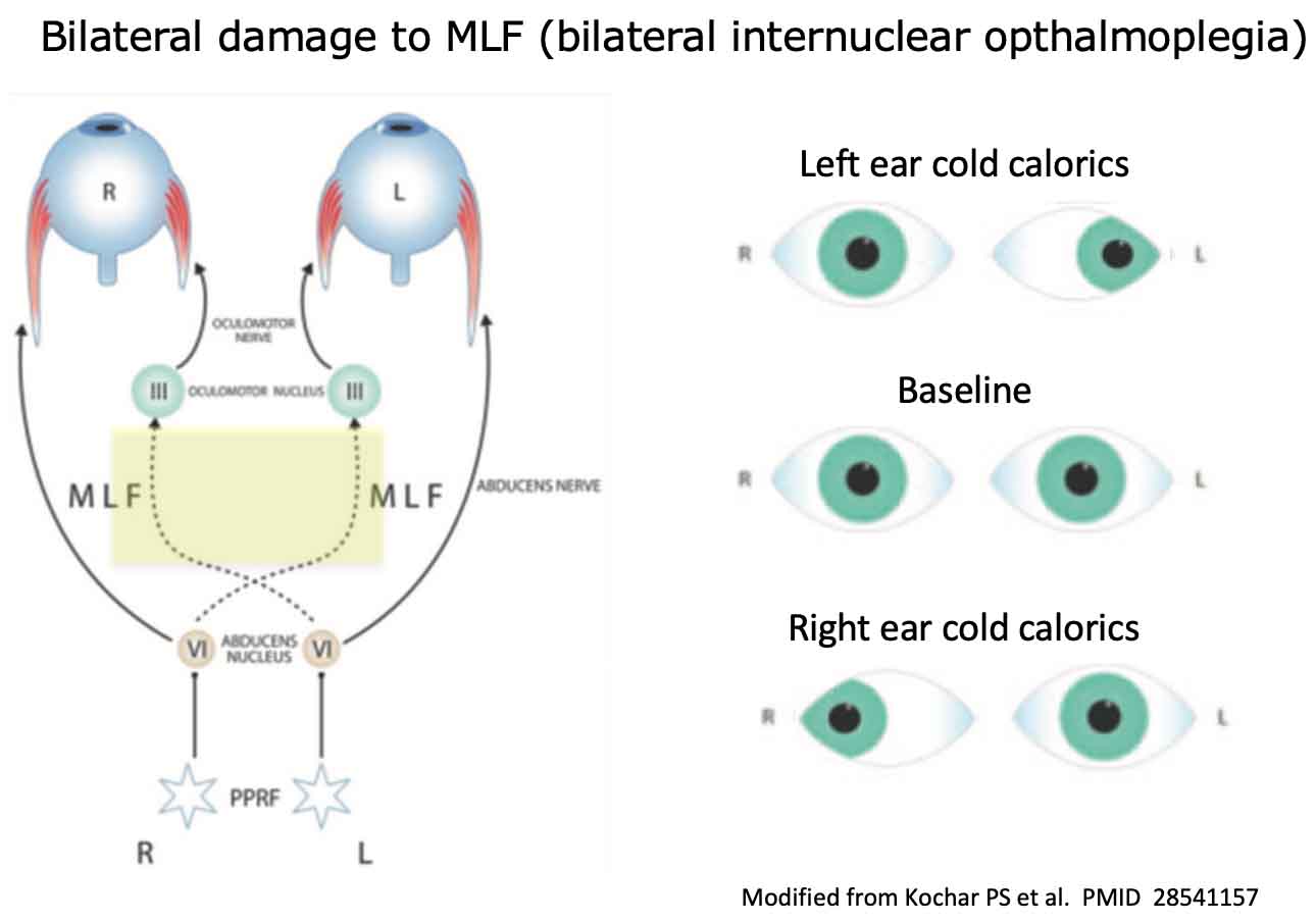 Internuclear Ophthalmoplegia
