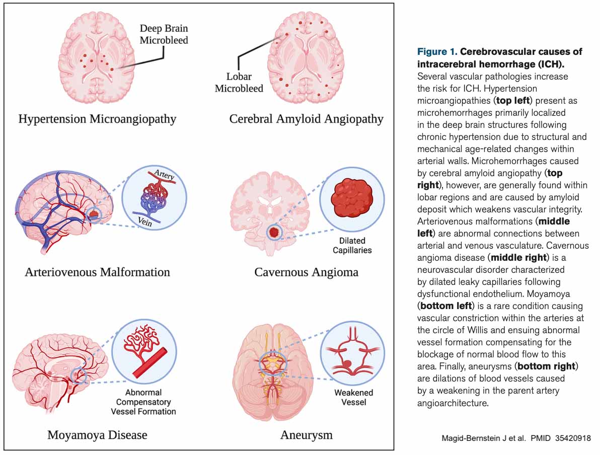 Brain Hemorrhage Types Causes And Prevention vrogue.co