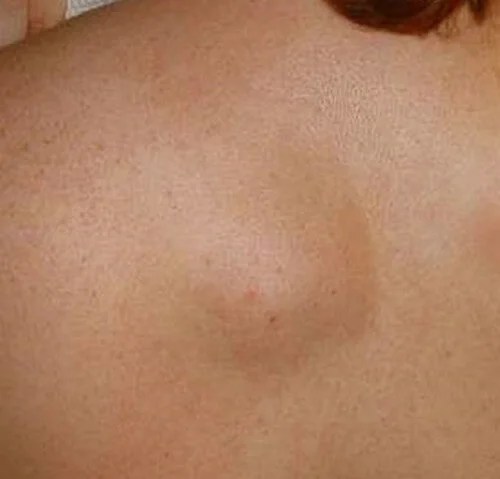 lipoma cyst pictures, photos