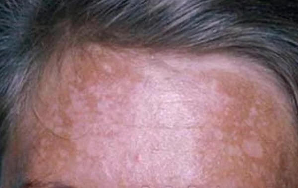Melasma (Chloasma) Pictures, Causes, Symptoms and Treatment (2018 Updated)