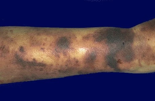 Ecchymosis Definition, Pictures, Symptoms, Causes, Treatment (2020