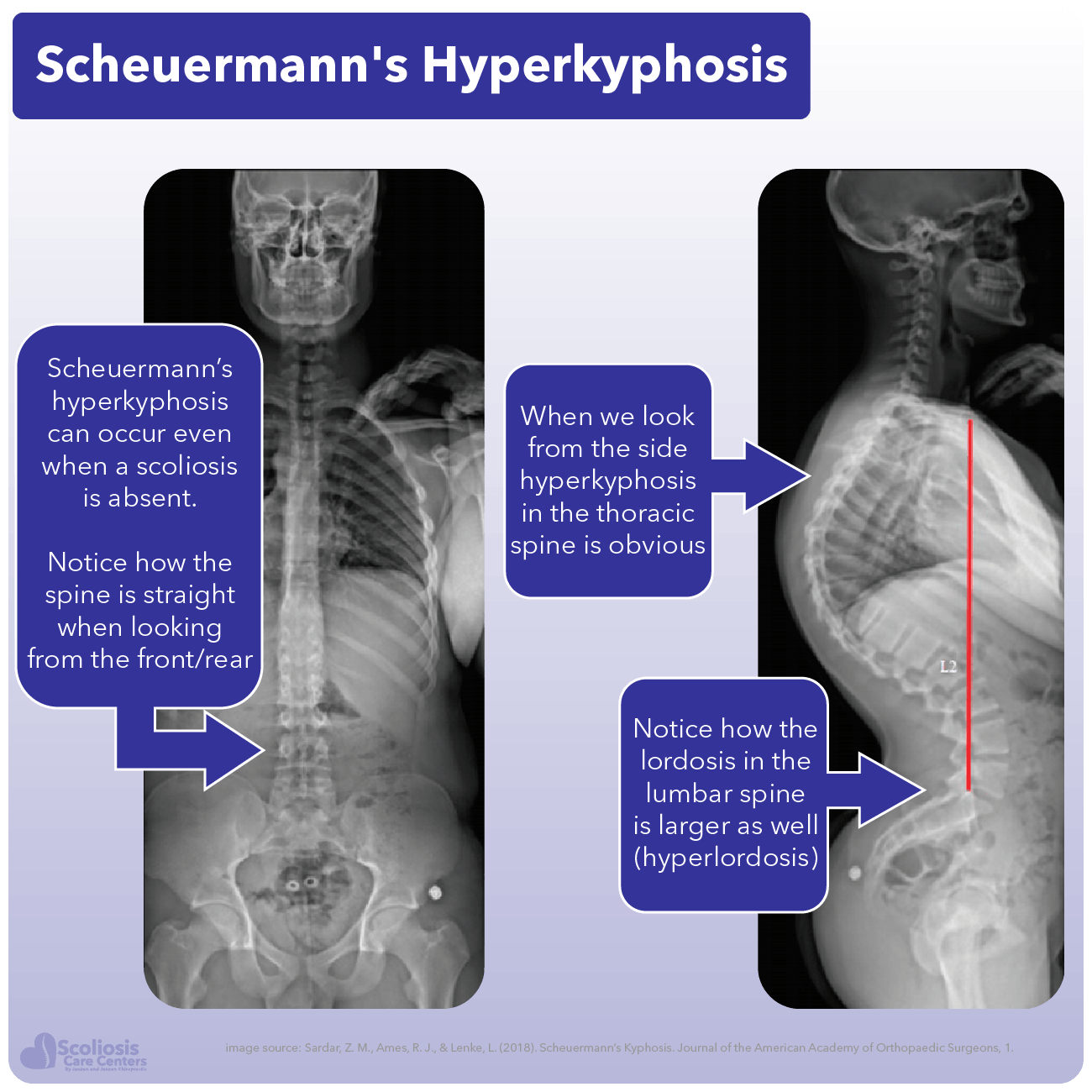 Scheuermann’s Kyphosis Treatments By Our Expert Physicians