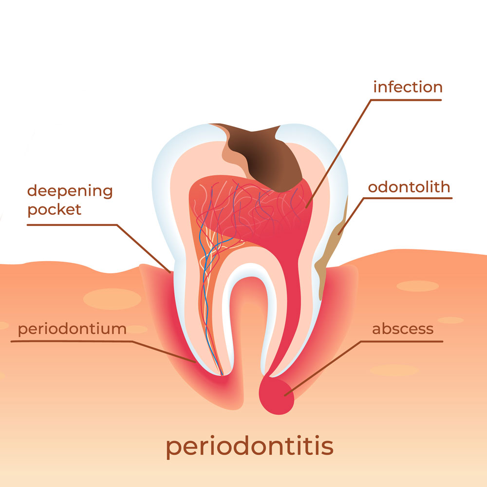Tooth Infection Treatment Emergency Dentist London