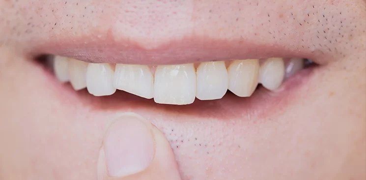 Is A Broken Tooth An Emergency 8 Tooth Bantuanbpjs