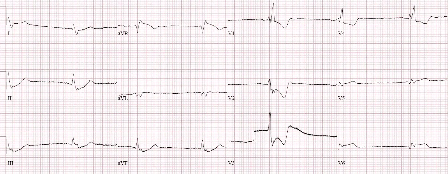 ECG Cases 15 Tall R Wave in V1 Emergency Medicine Cases
