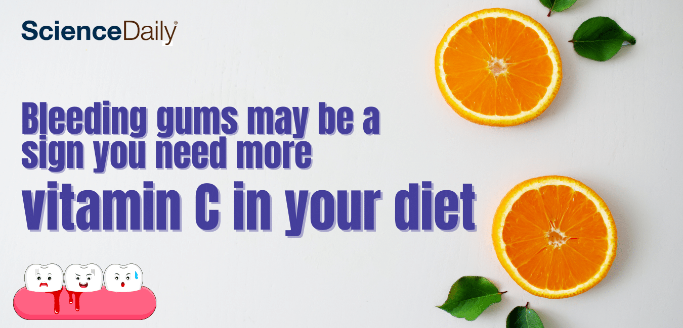 Bleeding Gums May Be A Sign You Need More Vitamin C In Your Diet Emerginnova