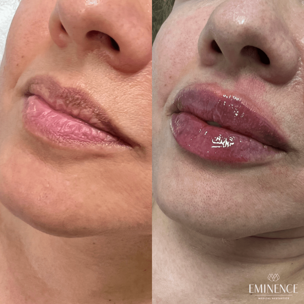 Lip Filler Results Princeton, Montgomery NJ Eminence