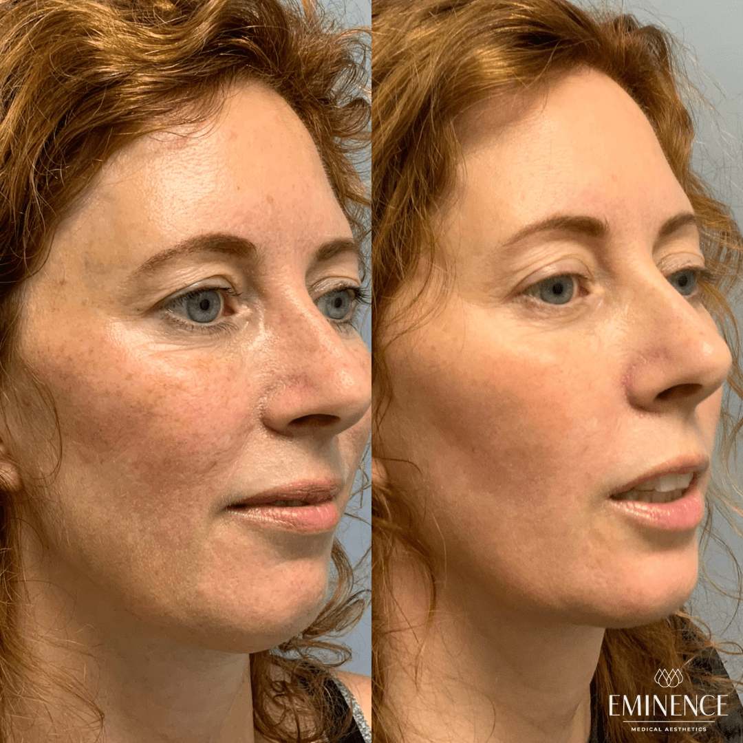 Laser Genesis Results Princeton, Montgomery NJ Eminence