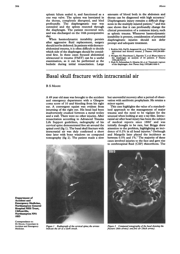 Basal skull fracture with intracranial air. Emergency Medicine Journal