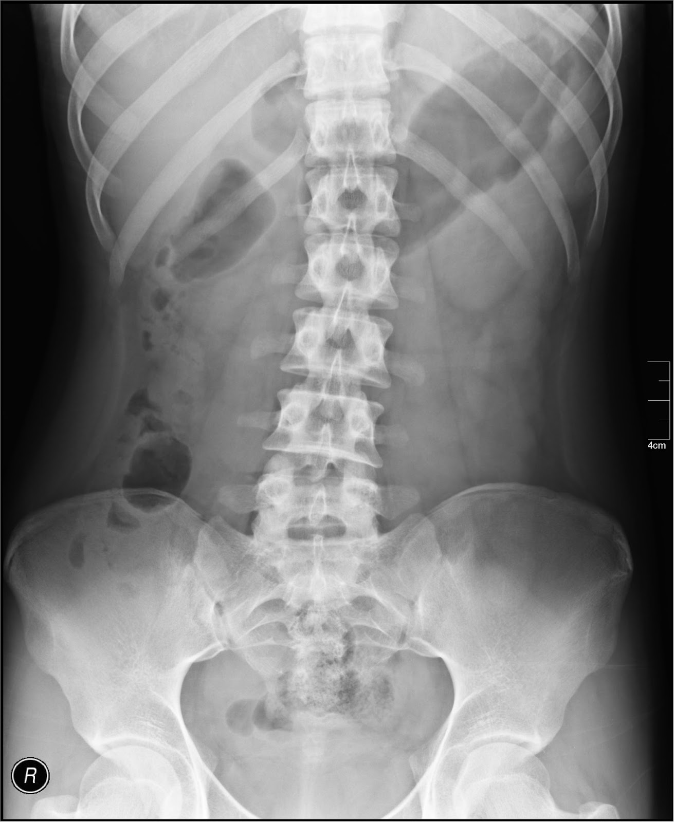 Abdominal XRays What's the Point? EMOttawa