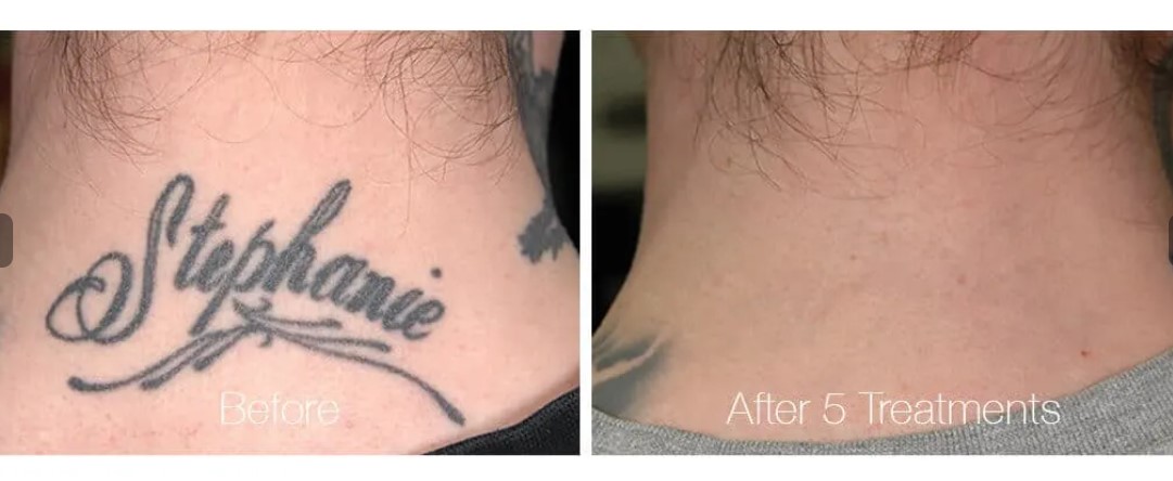 Is Laseraway Tattoo Removal Really Works? Facts Guide 2021