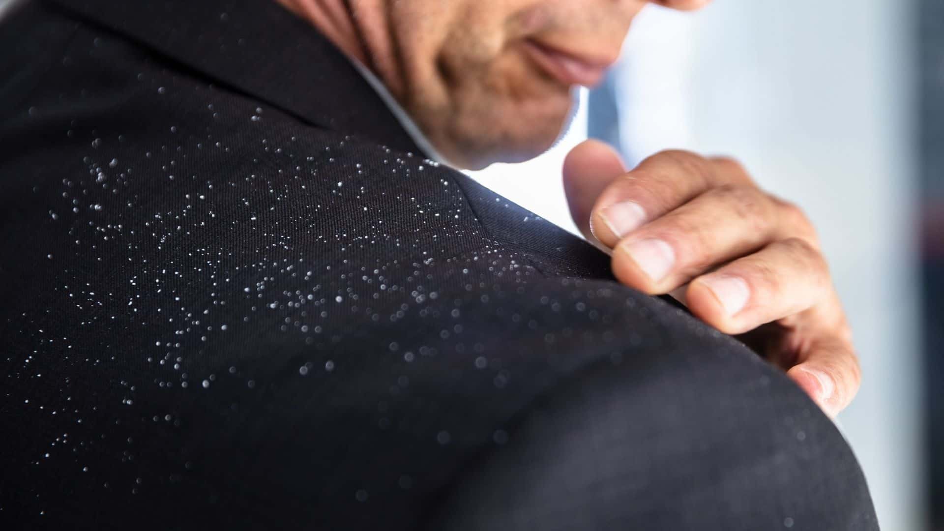 10 Causes of Dandruff and Symptoms with Myths Guide