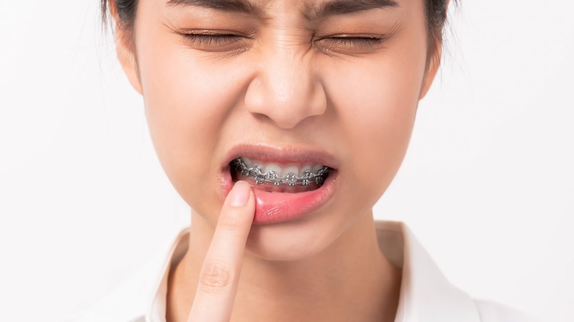 Learn What to do When Your Braces Cause Painful Mouth Ulcers