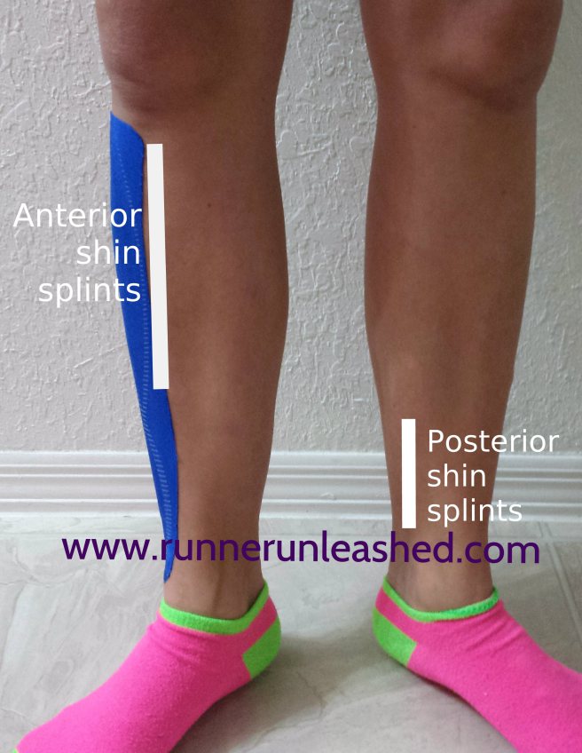 Cause, treatments, and prevention of shin splints Empire Unleashed