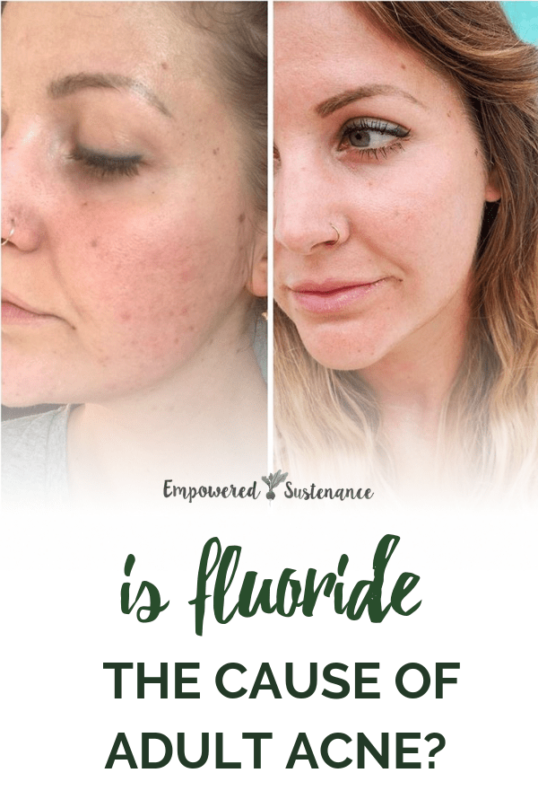 Is Fluoride the Cause of your Adult Acne? Empowered Sustenance