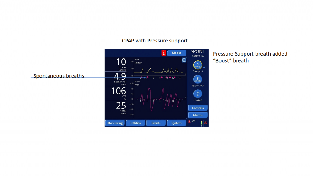 Demystifying Ventilator Modes It’s Not That Complicated! EMS Airway