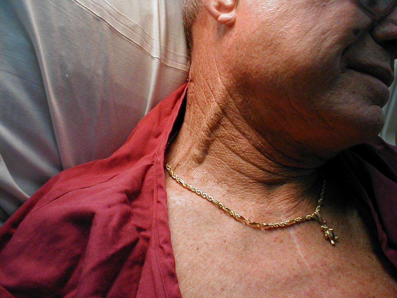 What it Looks Like Jugular Vein Distention