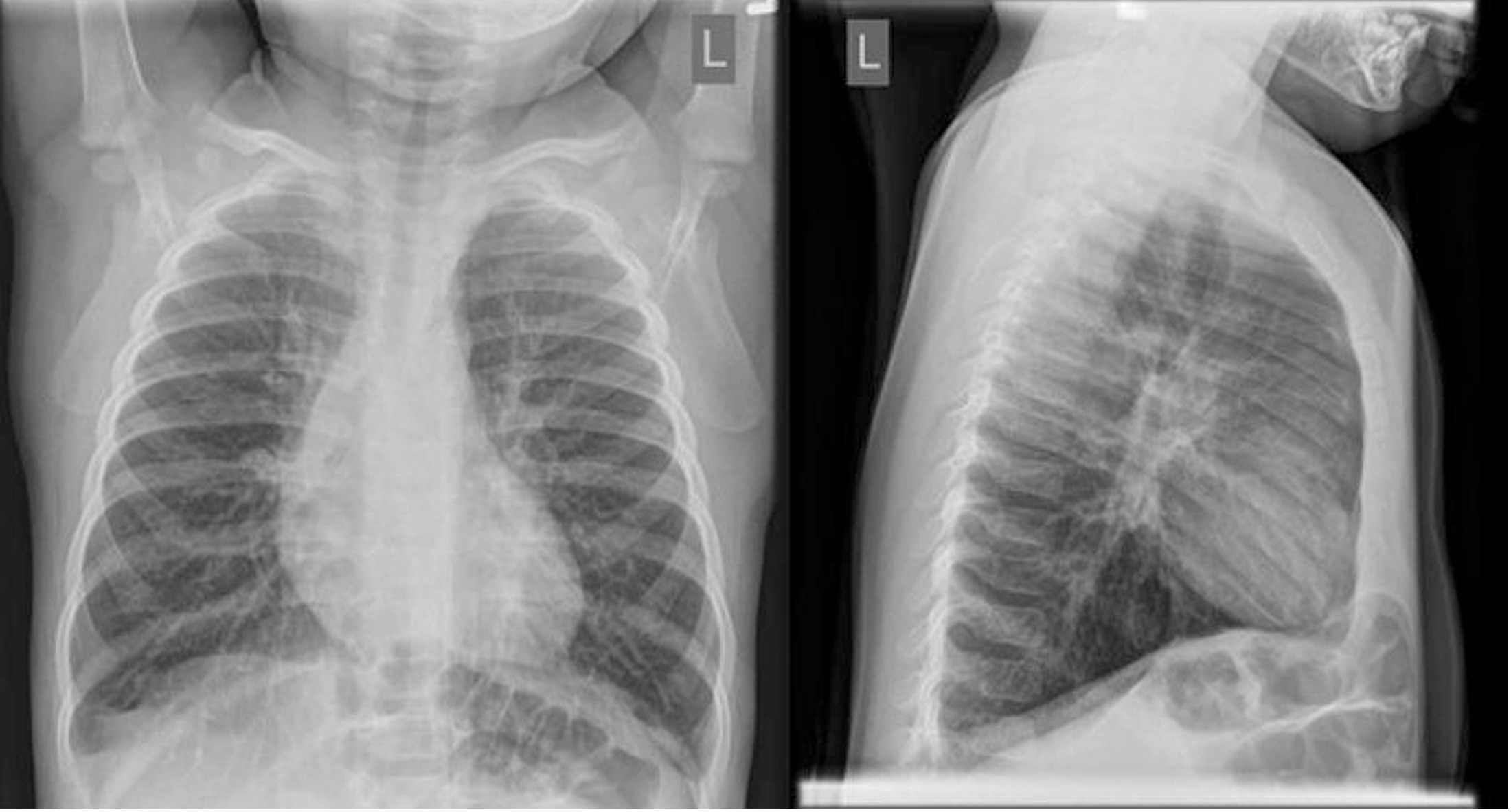 Bronchiolitis EM Sim Cases