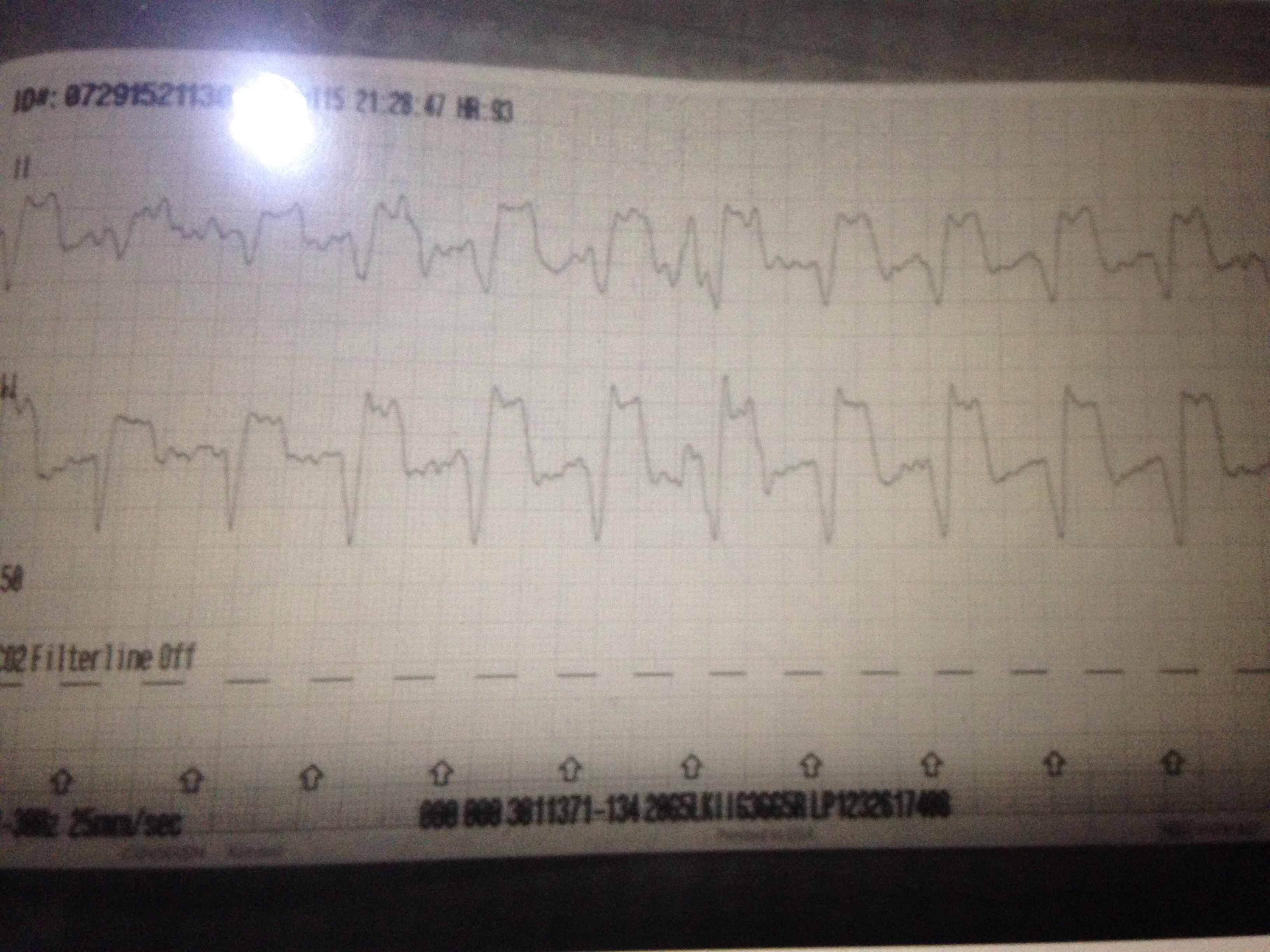 VTach vs Paced rhythm EMTLIFE
