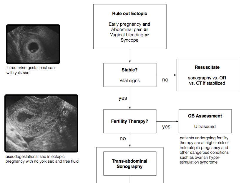 Rule Out Ectopic in the Emergency Department emupdates