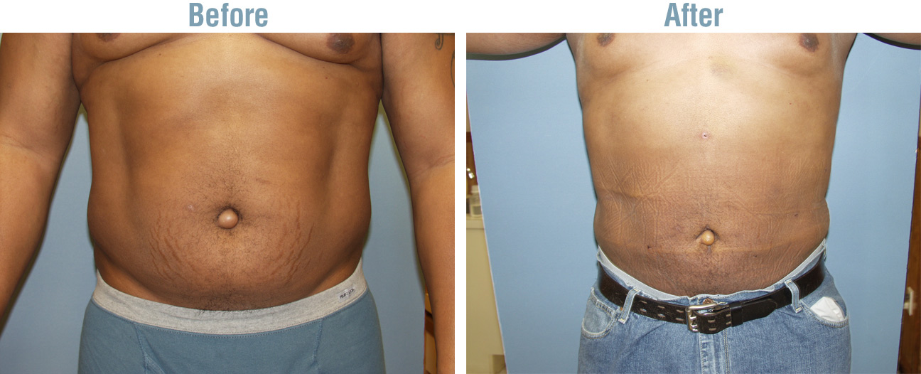 Liposuction Side Effects Are Important Weight Loss Surgery