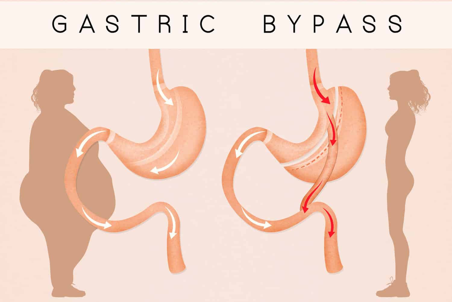 4 Gastric Bypass Complications Years Later Weight Loss Surgery