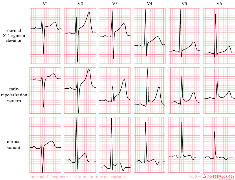 FileNormal ST elevation.png ECGpedia