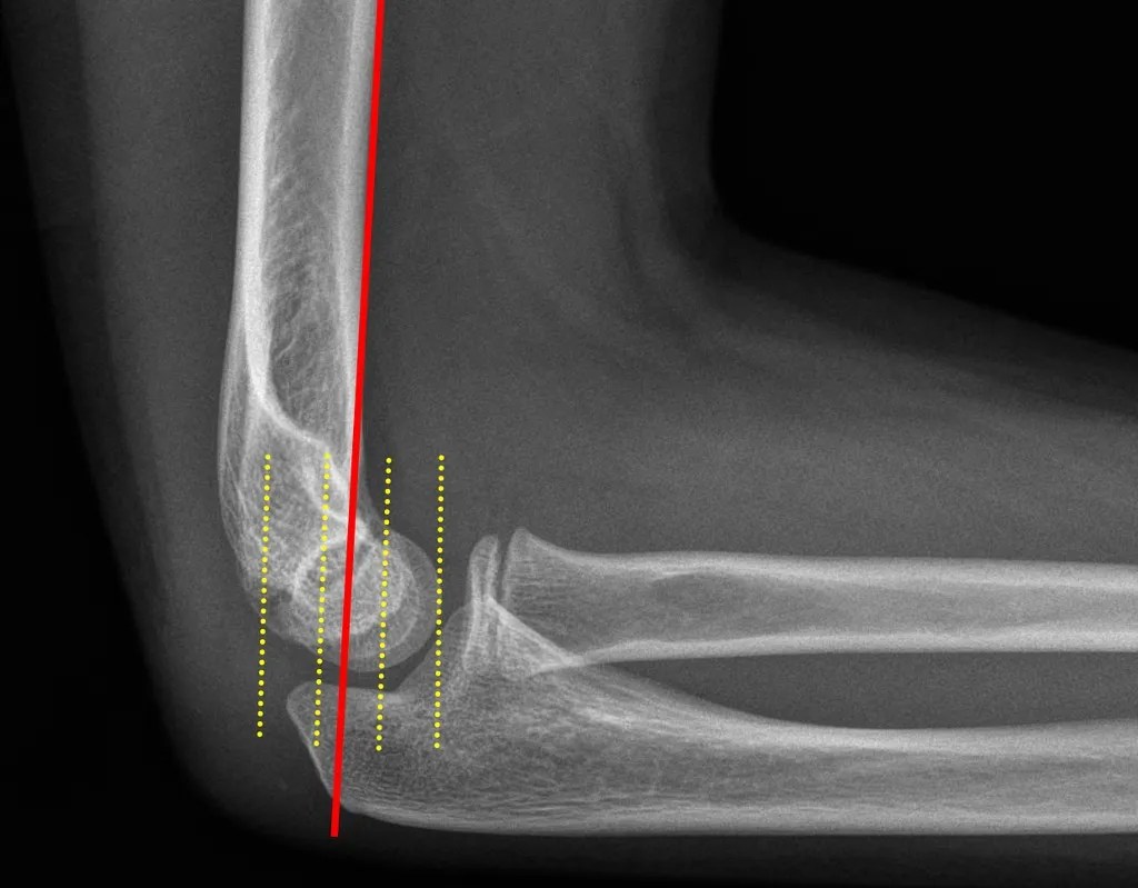 Supracondylar Elbow Fractures in Adults International Limb