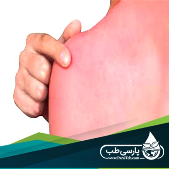 How to treat sunburn? (Part II) Parsi Teb