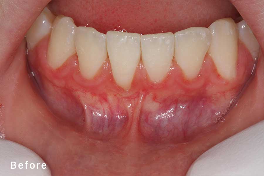 Frenectomy Encinitas Perio Daniel D Roberts DDS