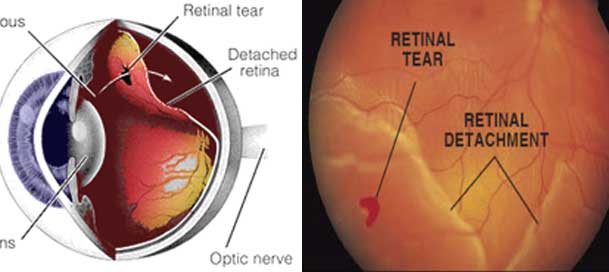 The retina is the thin layer of tissue at the back of the eye that is essential for proper vision. Detached Retina - Can It Be Prevented?