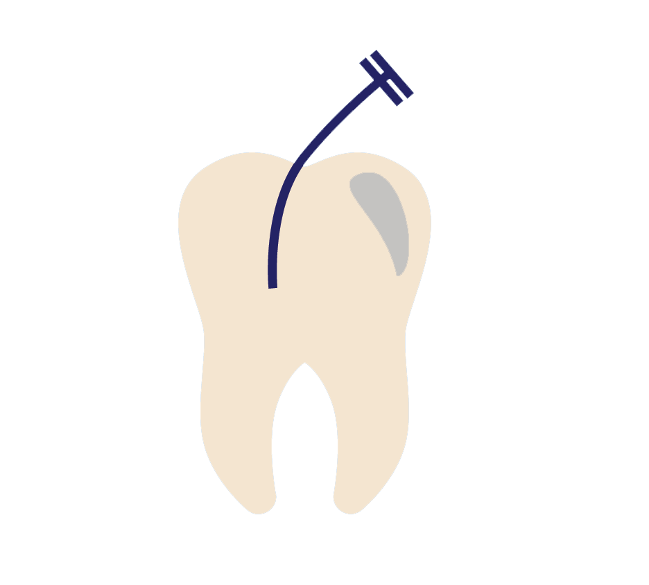 Endodontist in Jacksonville FL Dr. Daniella S. Peinado Root Canal