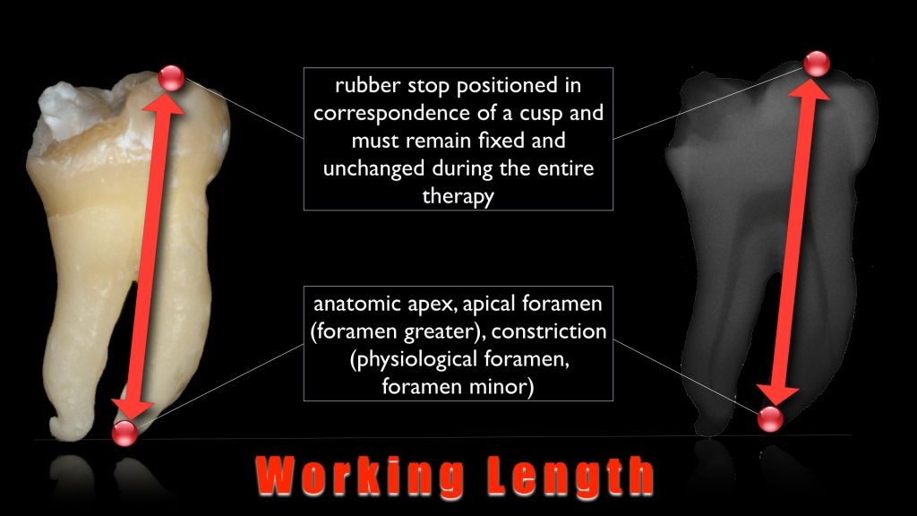 The working length Style Italiano Endodontics