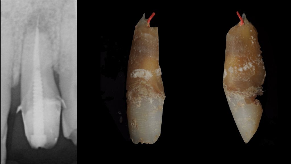 Overfilling Endodontic Failure Vs Clinical Success Style Italiano Endodontics