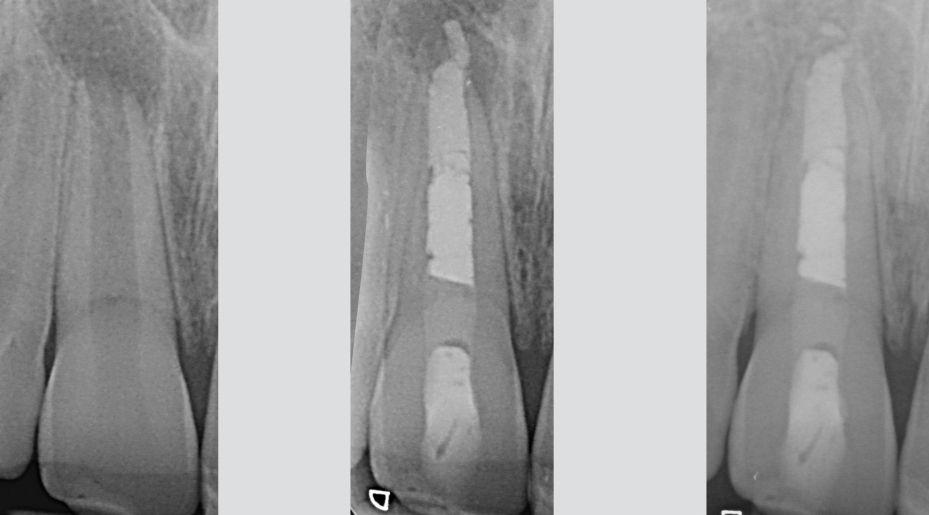 Overfilling Endodontic Failure Vs Clinical Success Style Italiano Endodontics