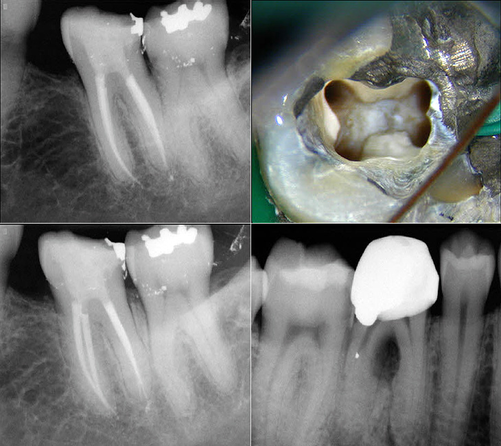 2 Separate Canals in Distal Root of Mandibular Molars.