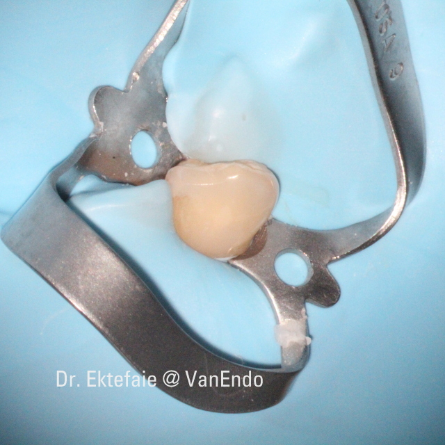 Tooth #3-3 under rubber dam isolation