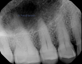 Pre-op radiograph of #14