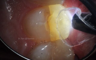 cracked tooth