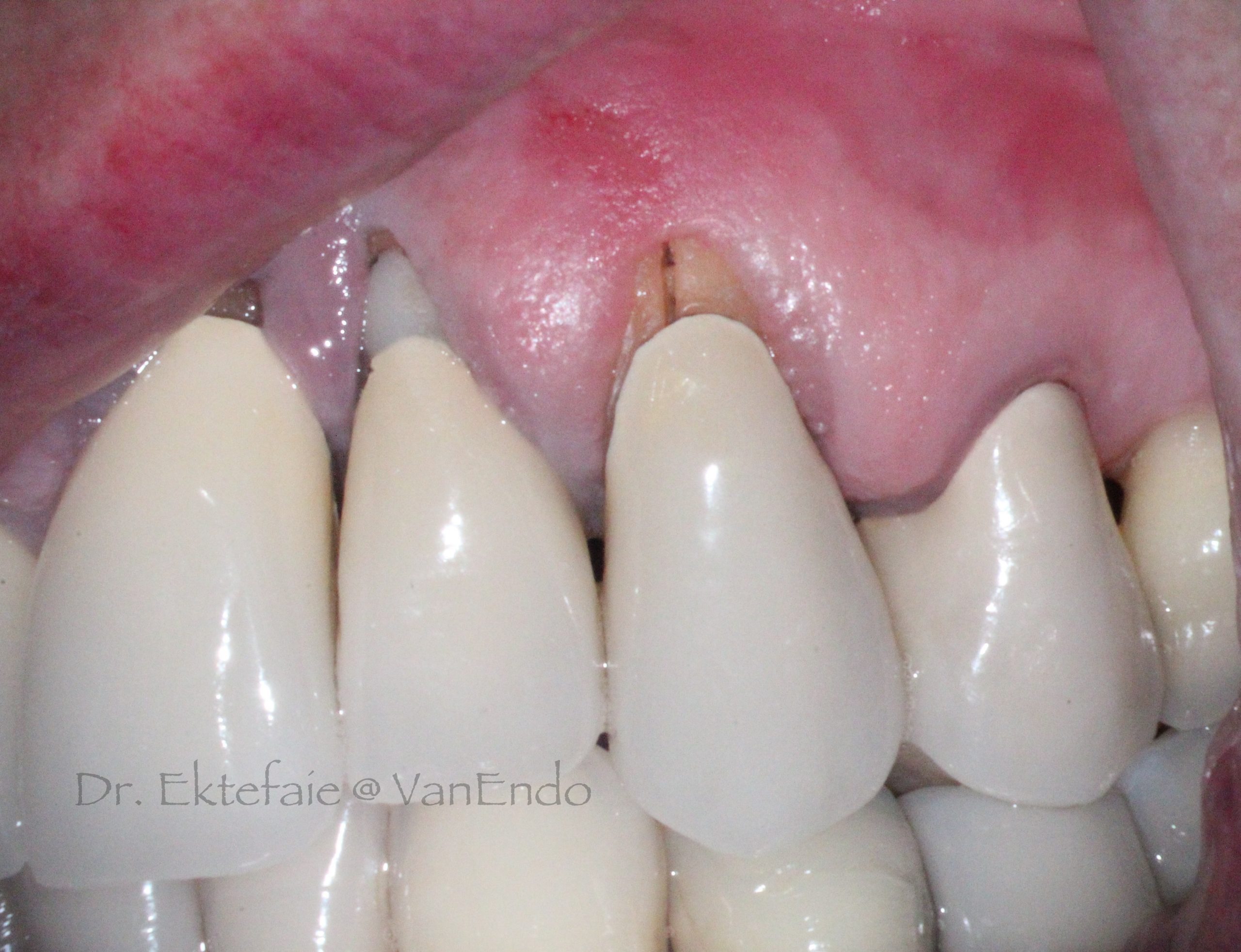visible vertical root fracture