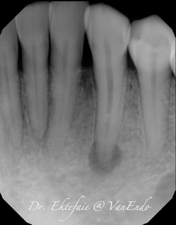 Pre-op radiograph of tooth #3-3