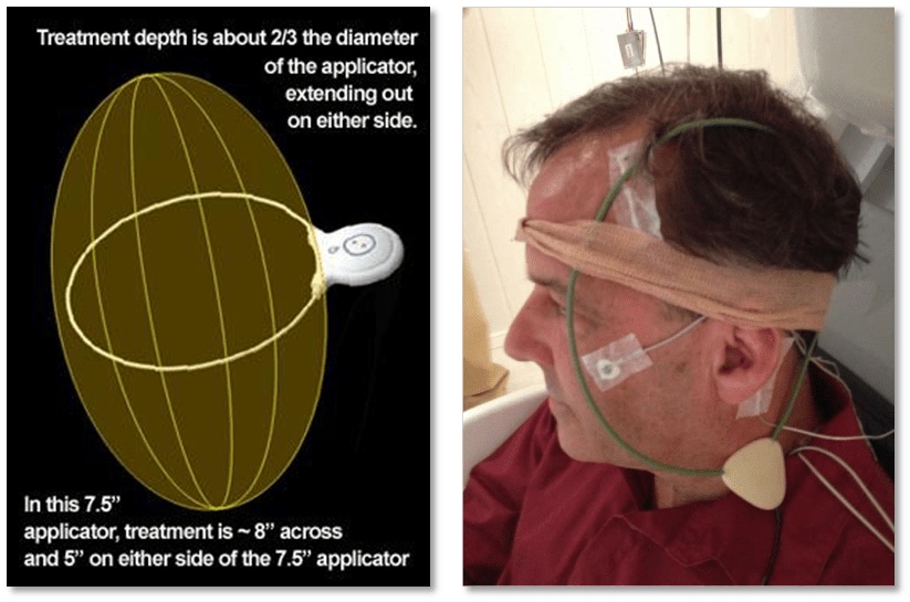 Electroceutical Therapies Therapy PFMF Endonovo