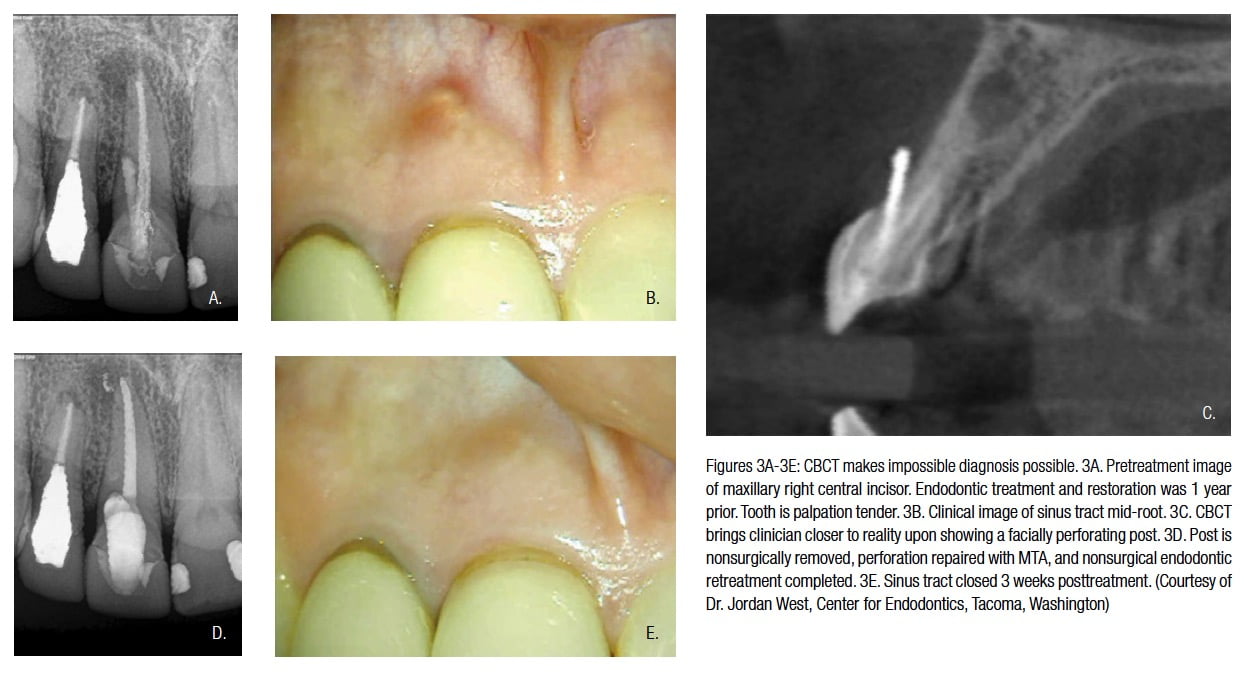 CBCT 3D imaging the next endodontic frontier of the great endodontist