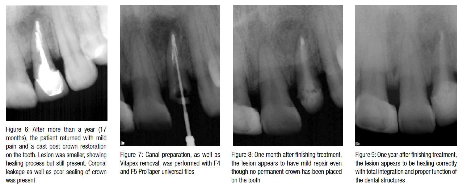 Endodontic CE Article Nonsurgical endodontic retreatment of extensive