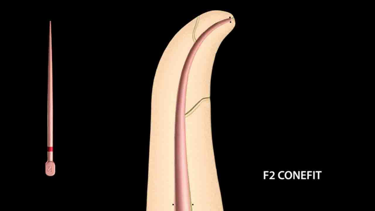 Rotary versus Reciprocation “How do I choose?” Endodontic Practice