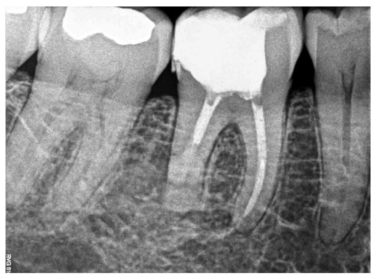 Treatment and maintenance of an external inflammatory root resorption