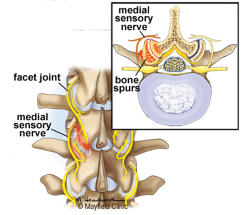 Facet Joint Syndrome Endospine Hellas