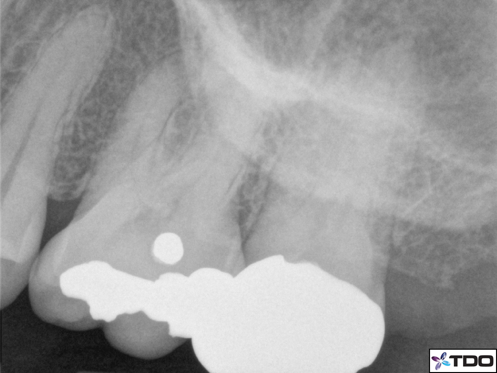 Deep Split Buccal Canals of Upper Second Molar the endospot