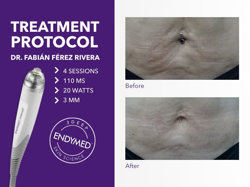 Why Dr. Fabian Perez Rivera chose ENDYMED 3DEEP® ENDYMED